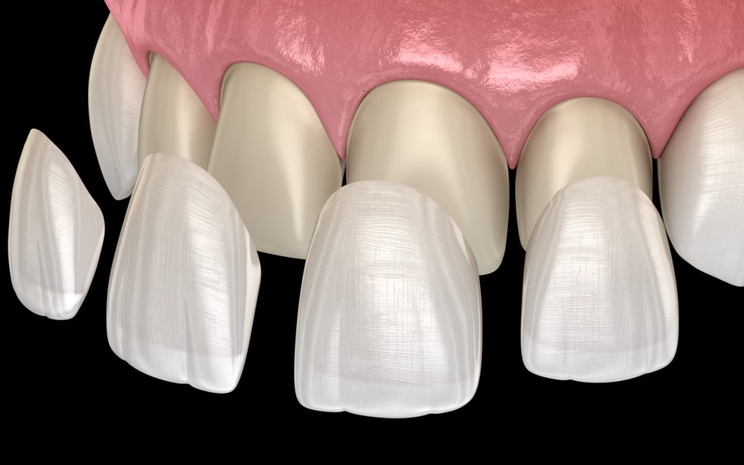 Faccette estetiche