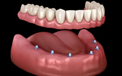 Overdenture