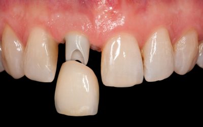 Capsule dentarie