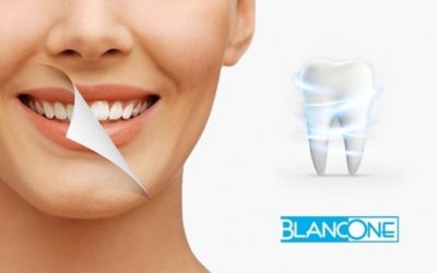 Sbiancamento dentale